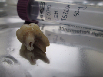 (7) A human tooth after drilling into the root